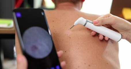 The doctor examines the moles on the man's back, slowmotion, close-up. Dermatologist visit, medical device