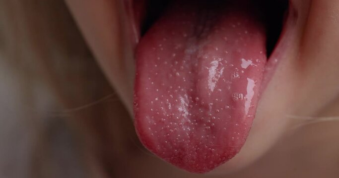 Girl with scarlet fever shows a red tongue covered in pimples. concept of illness, caring for a child.