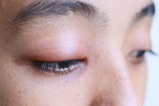 Close up of a boy with stye infection. Eyelid abscess, hordeolum in medical health, disease and treatment concept