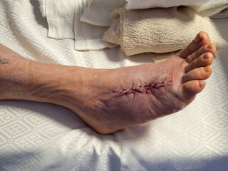 Surgery stitches after removal of a Stingray barb and debridement. Debridement is the medical...