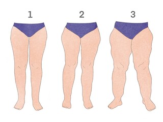 Piernas con tres estadios de lipedema. Ilustración estilo acuarela