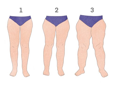 Piernas con tres estadios de lipedema. Ilustraci&oacute;n estilo acuarela