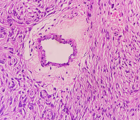 Olfactory groove tumor (biopsy): Brain cancer, Meningioma, show fibroblastic meningioma. Malignant...
