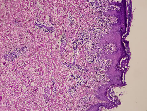Skin tissue biopsy: Lichen planus. show skin tissue, epidermis show hyperkeratosis, acanthosis, saw-toothing of rete ridges. band like lymphohistiocytic infiltration. Dermatitides.