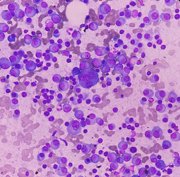 Bone merrow smear show 60 to 65 percent marrow nucleated cells. Macrocytic anemia. Plasma cell dyscrasia, multiple myeloma.