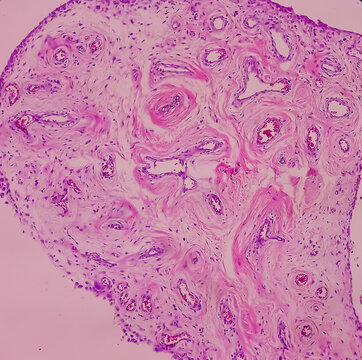 Microscopic image of Synovial tissue of knee joint. Baker's cyst. Ganglion cells, show microscopic view cyst wall composed of hyalinized fibrocollagenous tissue lined by synovium.