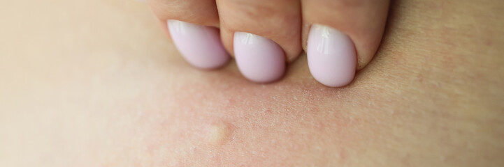 Female hand touches skin with rash examining eczema