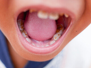 close up of black boy open mouth showing caries on teeth. health and dental care - Powered by Adobe