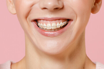 Close up cropped toothy smile of young happy woman with dental braces on teeth isolated on plain...