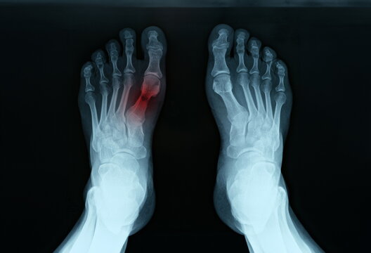 X ray of feet with tarsal fracture closeup. Diagnosis and treatment of lower limb injuries concept