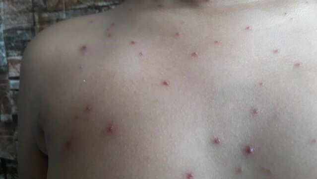 close up body of elementary age boy itching due to chickenpox. Wellness home care treatment chickenpox because varicella zoster virus. Selective focus