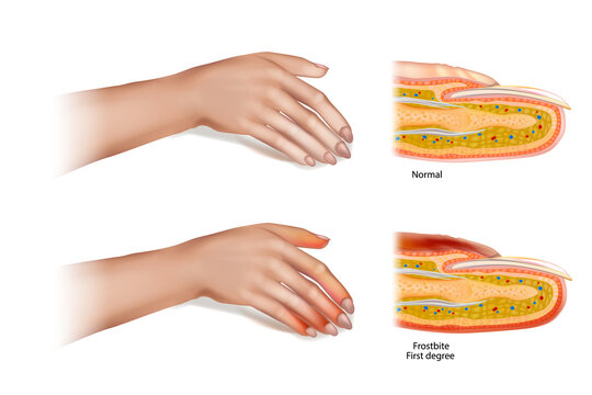 Frostbite First degree. Skin injury that occurs when exposed to extreme low temperatures, causing the freezing of the skin or tissues.