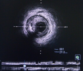 Intravascular ultrasound (IVUS) was performed cross-sectional and longitudinal of coronary artery.