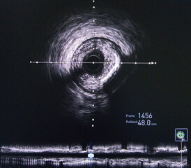 Intravascular ultrasound (IVUS) was performed cross-sectional and longitudinal of coronary artery.