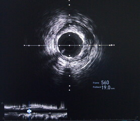 Intravascular ultrasound (IVUS) was performed cross-sectional and longitudinal of coronary artery.