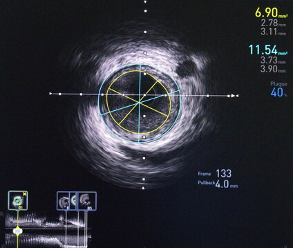 Intravascular ultrasound (IVUS) was performed measurement of coronary artery in cross-sectional view.