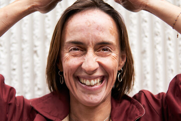 Smiling woman with skin condition showing her face