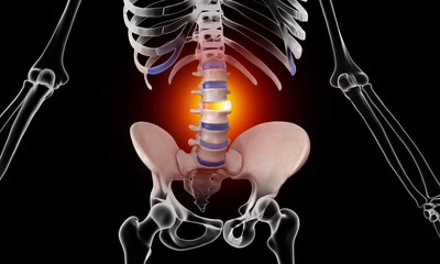 Bulging disc spinal injury skeleton 
medical illustration - obrazy, fototapety, plakaty