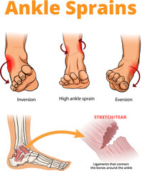 illustration of ankle sprains types