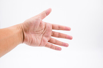 wrinkled or pruney hand because of soak in the water for a long time