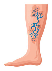 Stages or types of varicose veins development. Medical poster or disease infographic. Image of diseased legs. Vector illustration in flat style - obrazy, fototapety, plakaty