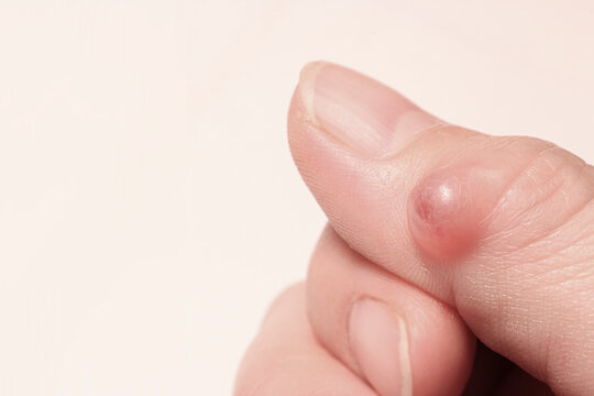 Ganglion cyst (synovial cyst disease) on the thumb of a woman&rsquo;s hand. Selective focus.