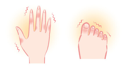 Obraz premium しもやけ・凍瘡で痒そうな手と足の指のイラストセット