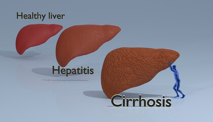 liver in norma, with fibrosis and cirrhosis, 3d render