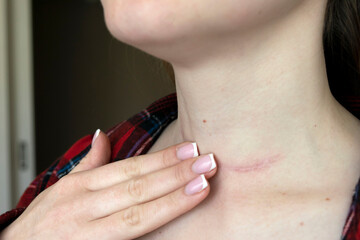 scar after surgery on woman neck