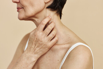 Close up of senior woman scratching neck with psoriasis spot suffering from skin condition, copy...
