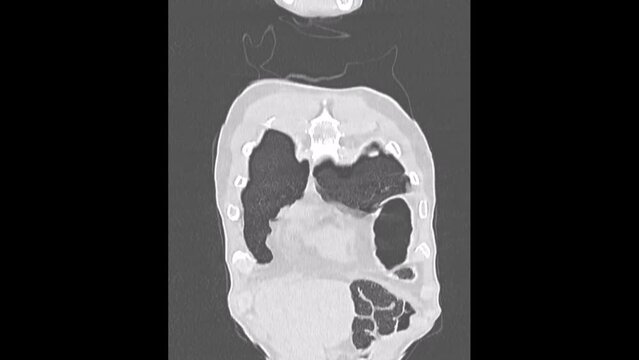 Diaphragmatic hernia  or Hiatus hernia, CT scan
