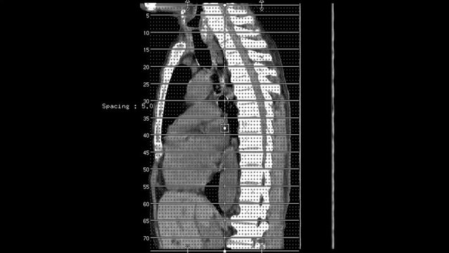 Diaphragmatic hernia  or Hiatus hernia, CT scan
