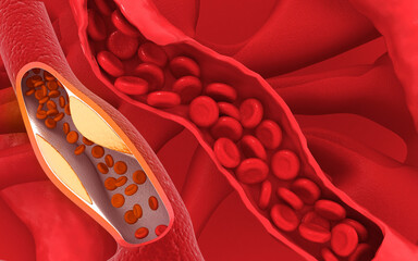 Clogged arteries on scientific background. 3d illustration.. - obrazy, fototapety, plakaty