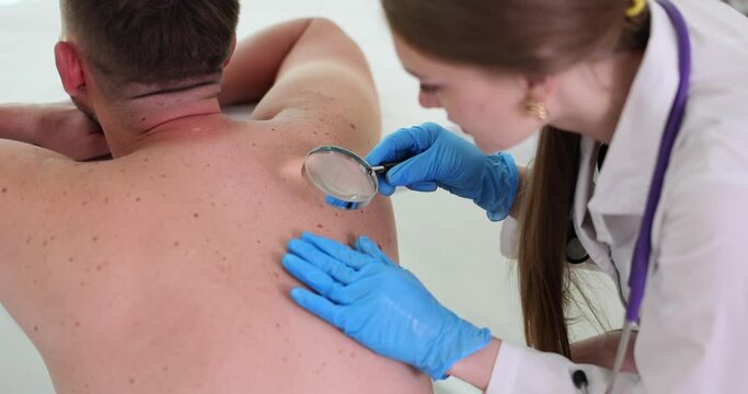 Dermatologist examines patient back with magnifying glass in clinic. Acquired melanocytic nevus and mole