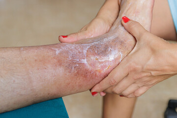 Home health care for an elderly person. Leg with ulcer due to diabetes. - obrazy, fototapety, plakaty