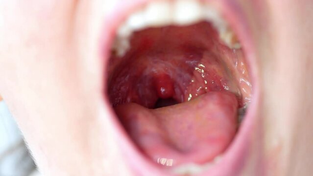 An open mouth of a woman indicates severe inflammation of the throat, red coloration of the mucous membrane, pharyngitis.