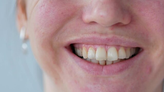 Smile of a woman with a dental stone close-up, dentistry. Big teeth, malocclusion. Problematic facial skin, red rashes on the skin, dermatology.