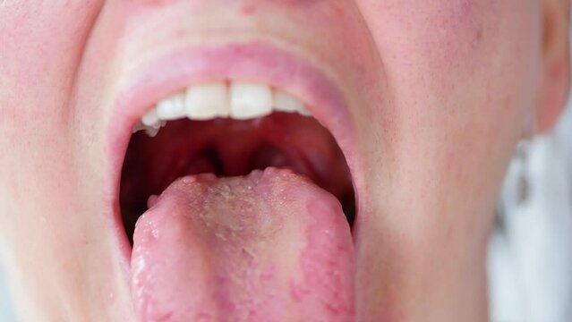 Enlarged papillae at the root of the tongue, glossitis, bacterial inflammation of the oral cavity.