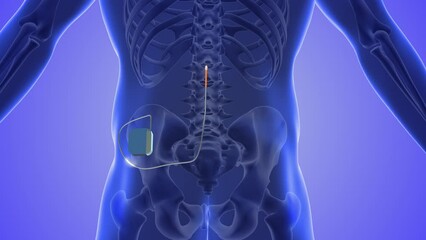 Spinal cord stimulation medical concept 