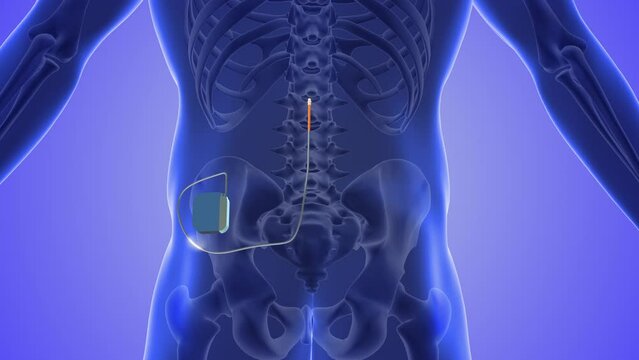 Spinal cord stimulation medical concept 