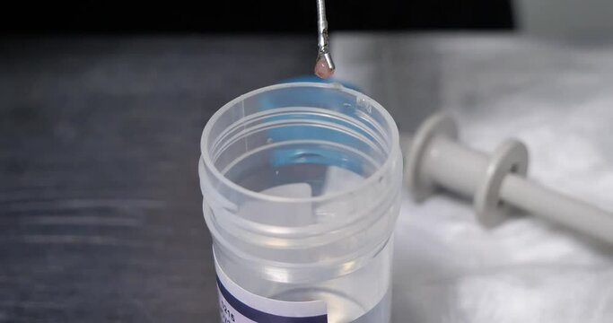 Close-up. The doctor's hands place a piece of tissue biopsy into a container with formaldehyde for histological examination. Concept pathomorphology, histology, biopsy, cancer.