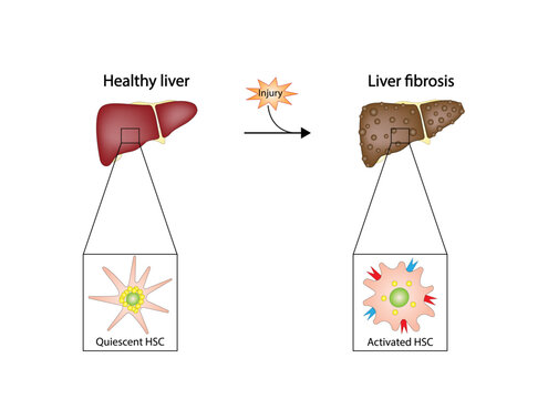 Liver fibrosis. Hepatic stellate cell, HSC. Quiescent HSC vitamin A storage. Activated HSC, collagen deposition. vector illustration