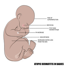Atopic dermatitis is a long-term skin disorder that usually appears in the early years of childhood.