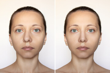 Shot of a woman's face with nose before and after rhinoplasty isolated on a white background. Cosmetic plastic surgery on the nose. Correction of the nasal septum. Septoplasty. Full face close up - obrazy, fototapety, plakaty
