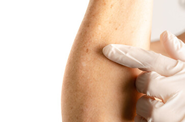 Doctor with white glove pointing at forearm of white woman with nevus, moles, spots on the skin, isolated white background. Skin diseases. Insolation. Sun spots. Close up. Dermatology. Skin cancer.