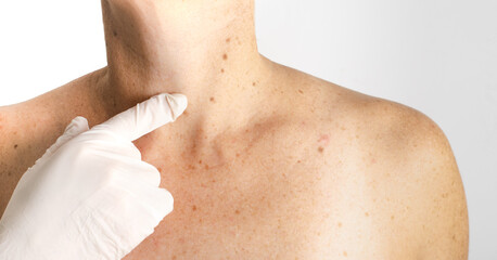 Doctor with white gloves pointing at white woman, nevus, moles, spots on the skin, isolated white...