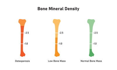 Bone Mineral Density Level Concept Design. Vector Illustration.	
