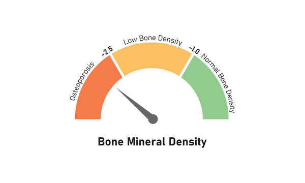 Bone Mineral Density Level Concept Design. Vector Illustration.	