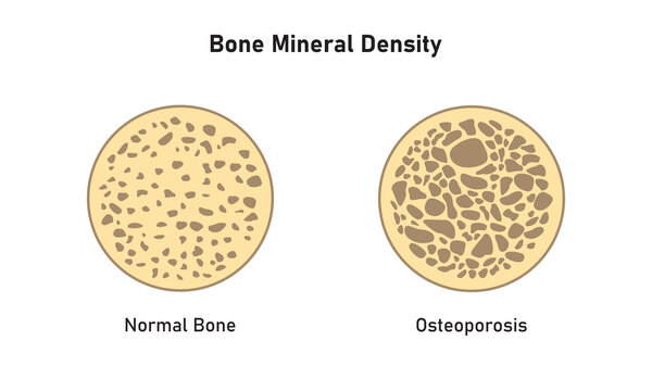 Osteoporosis (BMD) Concept Design. Vector Illustration.	