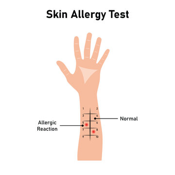 Skin Allergy Test Scientific Design. Vector Illustration.